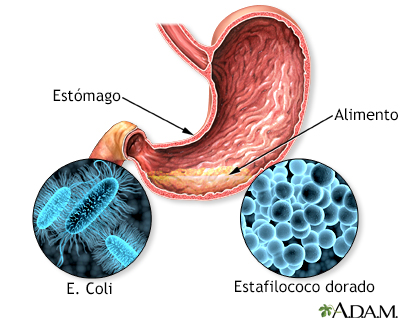 Intoxicación alimentaria