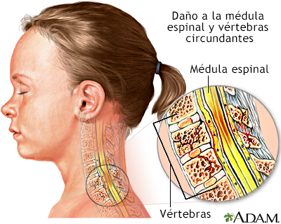 Lesión a la médula espinal