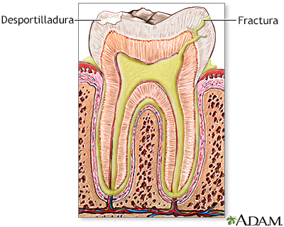 Diente fracturado