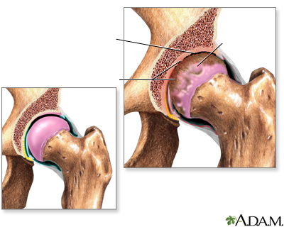 Artritis en la cadera