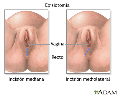 Episiotomía