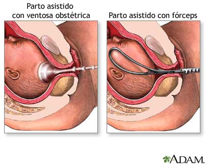 Fórceps/Ventosa Obstétrica