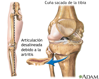 Procedimiento