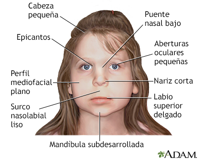 Síndrome de alcoholismo fetal