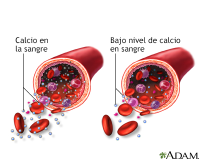 Hipocalcemia