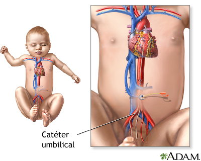 Catéter umbilical