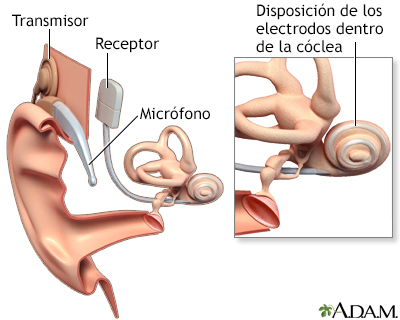 Implante coclear