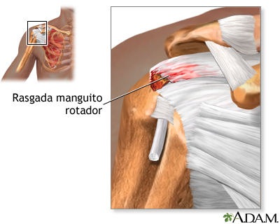 Desgarro del manguito rotador