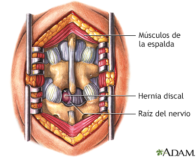 Microdiscectomía - Indicaciones