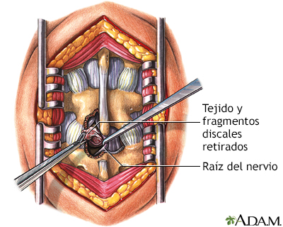 Microdiscectomía - Procedimiento