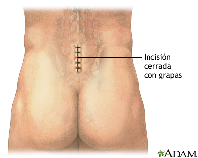 Tratamiento posoperatorio