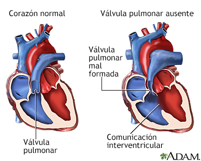 Válvula pulmonar ausente