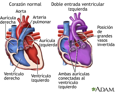 Doble entrada ventricular izquierda