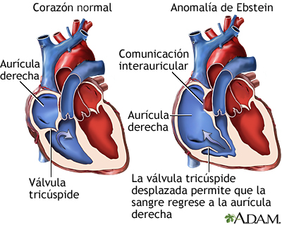 Anomalía de Ebstein