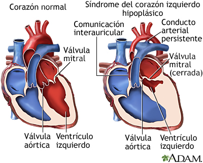 Síndrome del corazón izquierdo hipoplásico