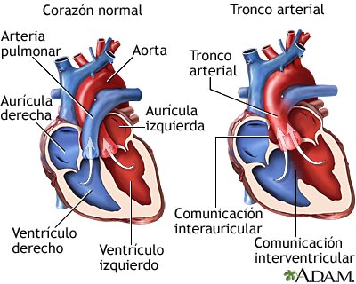 Tronco arterial