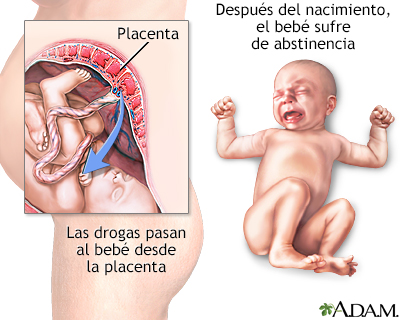 Síndrome de abstinencia neonatal