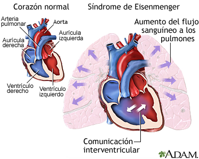 Síndrome de Eisenmenger (o complejo)