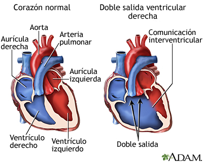 Doble salida ventricular derecha