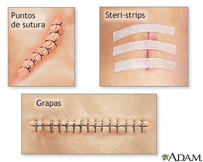 Cierres de incisiones