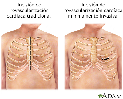 Incisión de cirugía de revascularización cardíaca