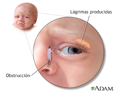 Obstrucción del conducto lagrimal