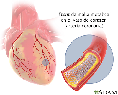 Stent de arteria coronaria