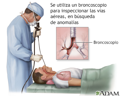 Broncoscopia