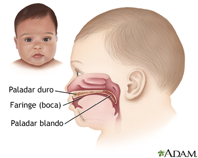 Cirugía de labio y paladar hendido - serie