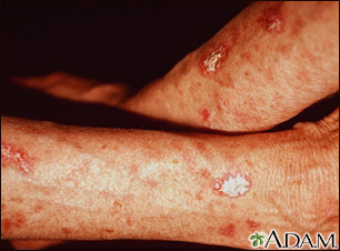 Queratosis actínica en el antebrazo