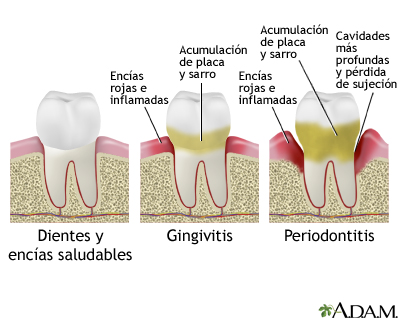 Periodontitis