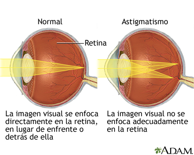 Astigmatismo