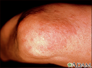 Granuloma anular en el codo