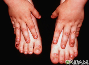 Epidermólisis bullosa, distrófica