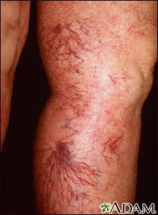 Telangiectasia en las piernas