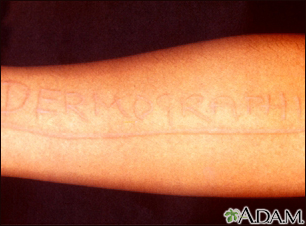 Dermatografismo del brazo