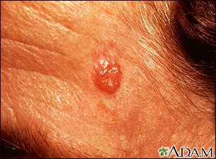 Carcinoma de célula basal en la cara