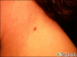 Queratosis seborreica irritada en el cuello