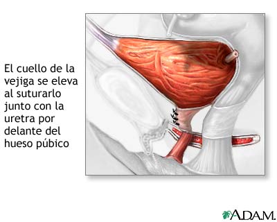 Procedimiento