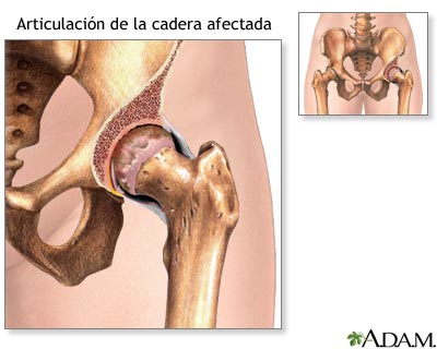 Cadera afectada