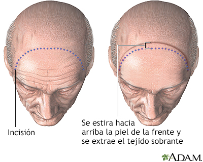 Estiramiento de la piel de la frente - Procedimiento