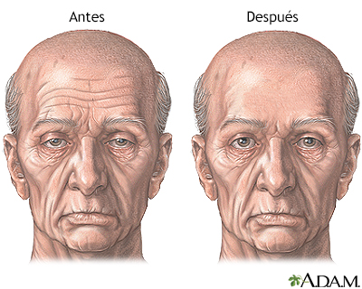 Antes y después de estiramiento de la frente - Cuidados postoperatorios