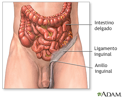 Reparación quirúrgica de una hernia inguinal - serie