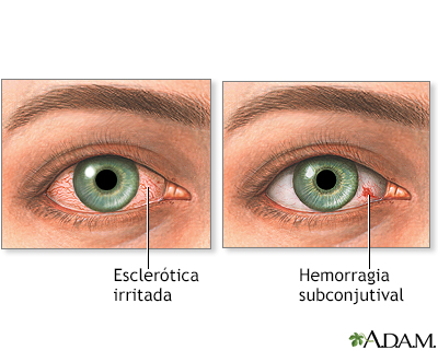 Ojos inyectados de sangre