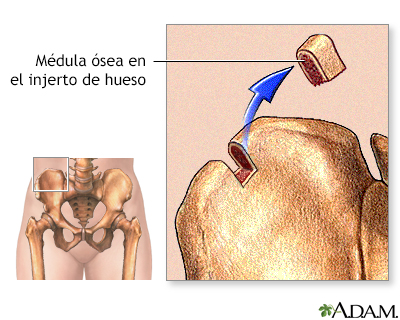 Médula ósea de la cadera