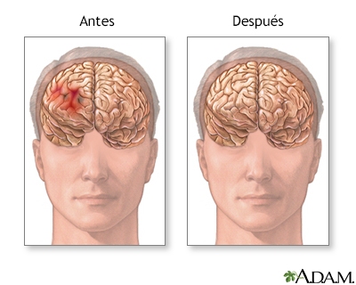 Antes y después de la reparación de un hematoma