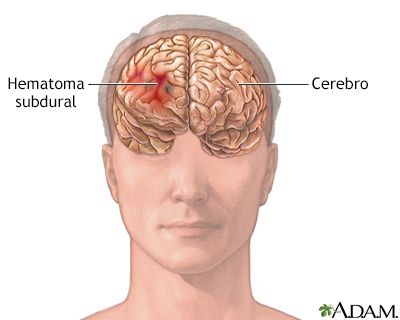 Hematoma subdural