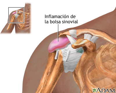 Bursitis del hombro