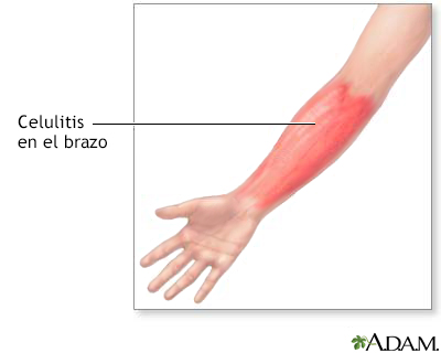 Celulitis en el brazo