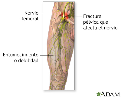 Daño al nervio femoral